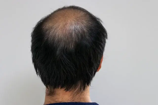 なぜ30代が終わって40代に入るとAGA発症率が急増する?
