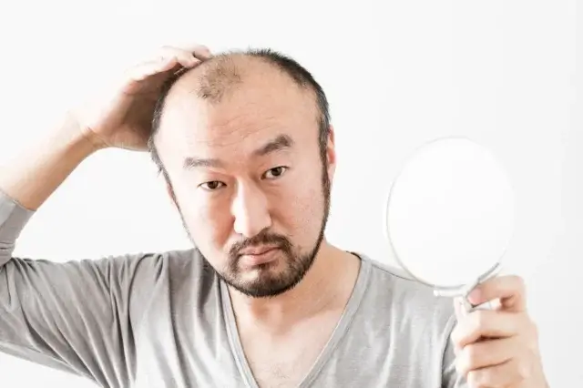 50代の薄毛はAGAと加齢のどちらが原因？