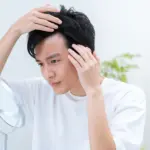 若年性脱毛症とは？10代・20代の薄毛の原因と見分け方、対策を徹底解説