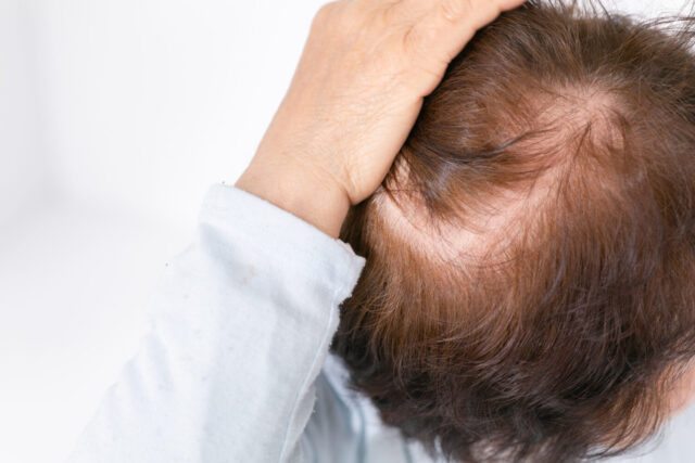 内臓の病気が原因の円形脱毛症とは？