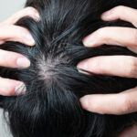 円形脱毛症の治療方法11種類とは？やってはいけないこと・すべきこと徹底解説！