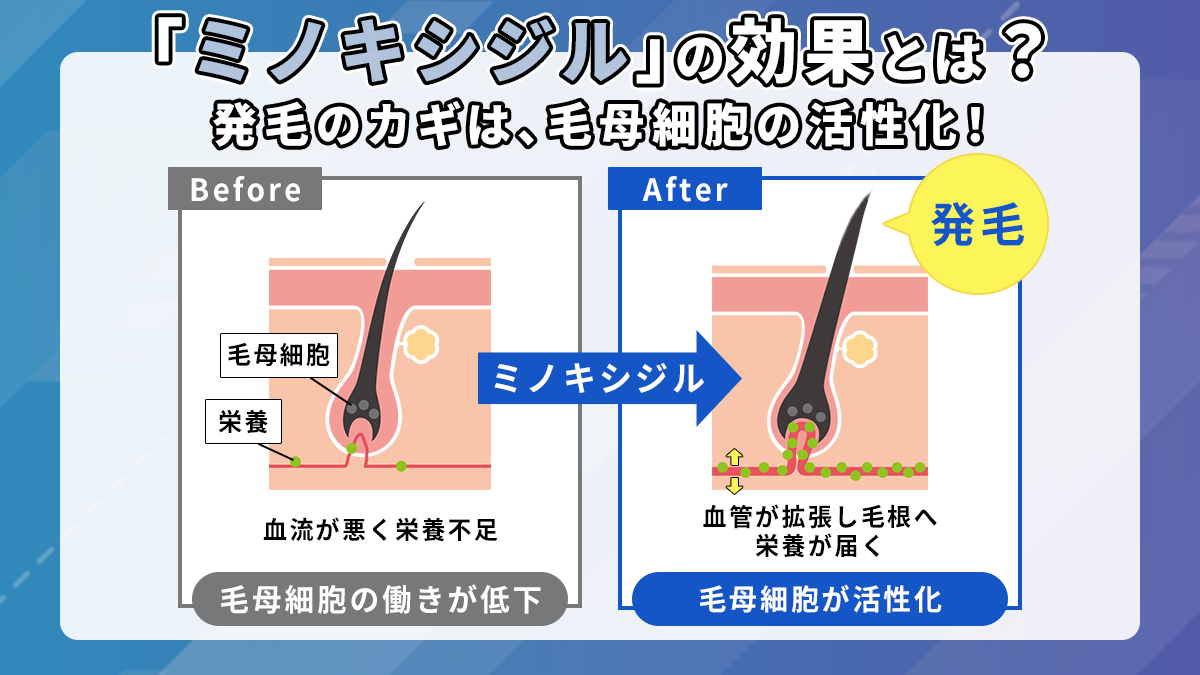 ミノキシジルの効果
