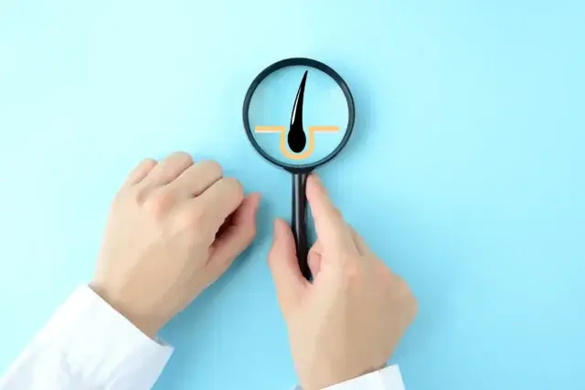 AGAの原因と進行パターン