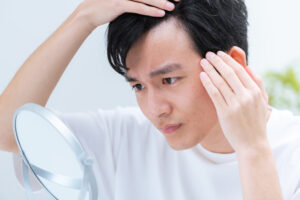 前頭部の薄毛はAGAが原因?判断方法・原因・治療法を専門医が解説