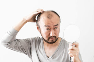 薄毛の原因DHT(ジヒドロテストステロン)とは？AGAとの関連や抑制方法を徹底解説