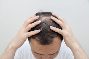 脂漏性脱毛症完全ガイド!症状の特徴・原因・完治に向けた最新治療法を解説