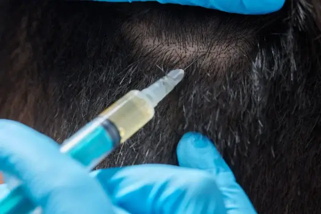 毛髪再生医療の主な治療法とその特徴