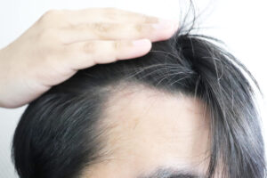 前髪がスカスカになる原因と改善方法を解説!AGA治療や生活習慣で薄毛を防ぐ