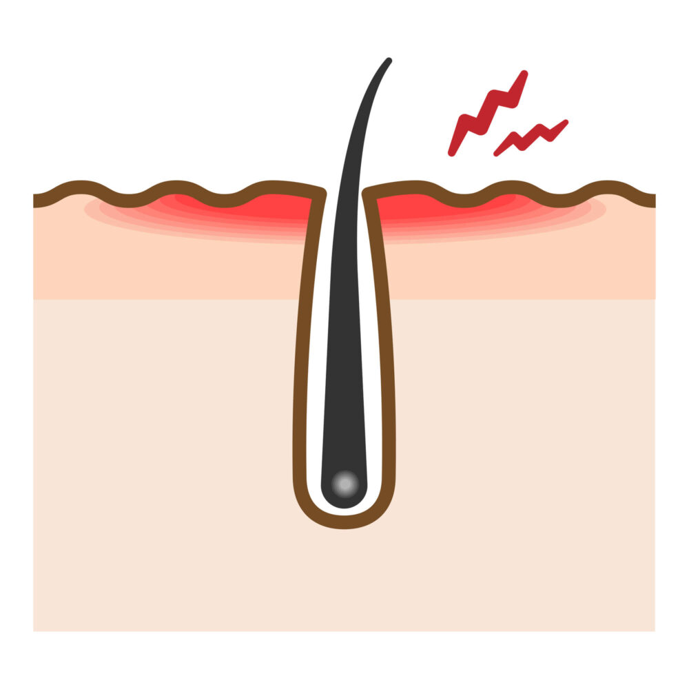 その頭皮の症状、本当にAGAだけ？