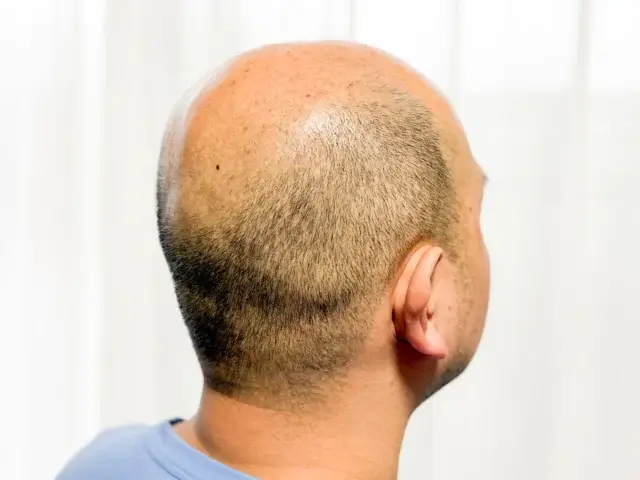 ストレス・睡眠不足でホルモンバランスが崩れるとAGAは進行する?