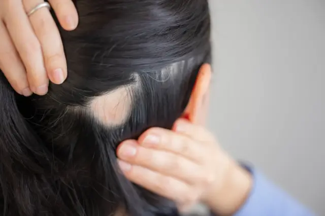 女性の薄毛の典型的症状