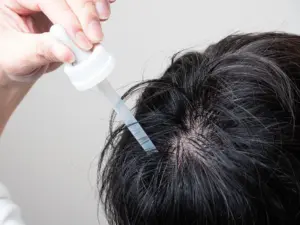 ミノキシジルをやめてよかった!は本当?中止を決める前に医者に聞くべきポイントを徹底解説!