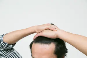 AGAの進行速度はどれくらい?現状を測るセルフチェック方法・5年後の髪を守る方法を専門医が完全解説!