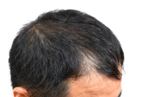 壮年性脱毛症とは？AGAとの違い・典型的症状・セルフチェック方法と対策を専門医が解説！