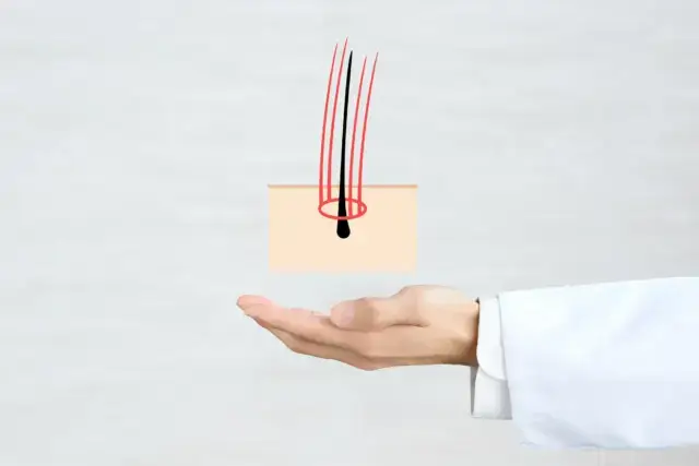 ミノキシジルの心臓への副作用が不安なら…他にどんな治療法がある？