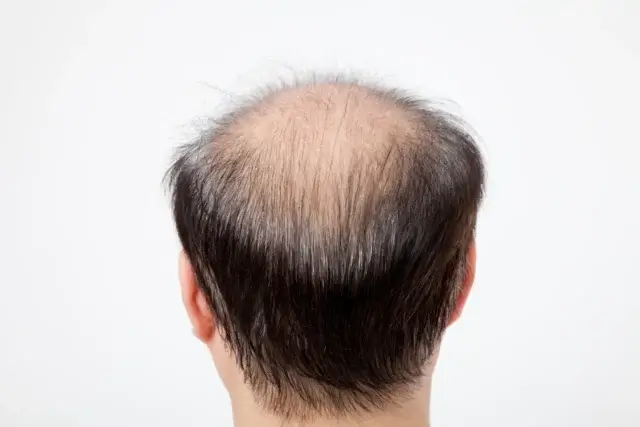 デュタステリドの効果が出にくい人の特徴は?