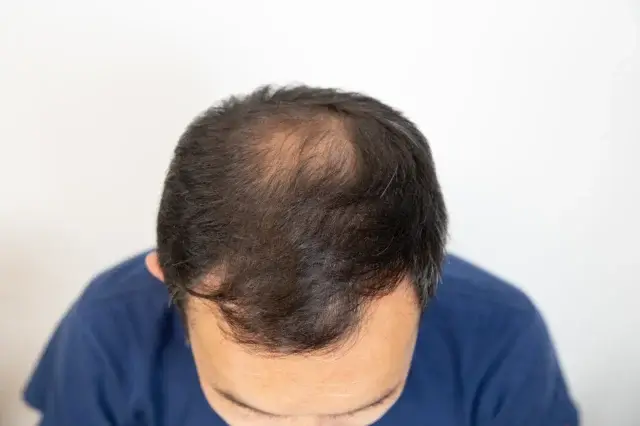 副作用リスクはデュタステリドとミノキシジルの併用でどうなる？