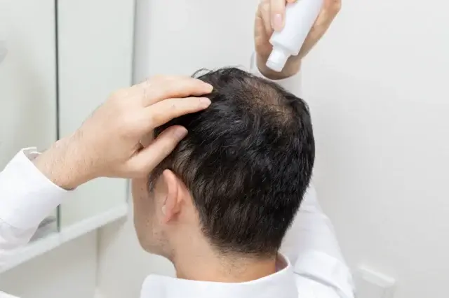 デュタステリドとミノキシジルの併用治療でどれくらい効果出る？