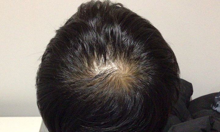 京都のAGA・薄毛治療専門院の発毛症例