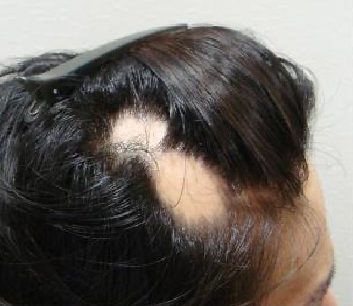 Alopecia areata treatment - 大阪AGA加藤クリニック