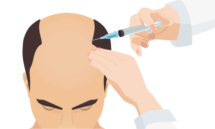 SDHG療法（自己真皮毛包細胞移植）&reg;