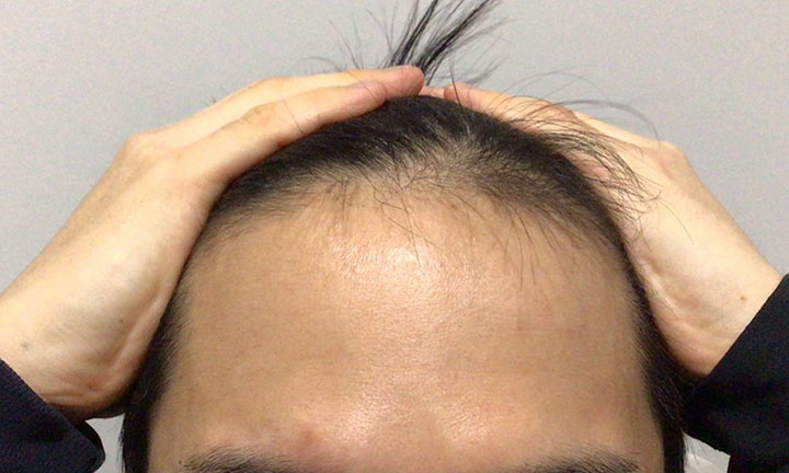 京都のAGA・薄毛治療専門院の発毛症例