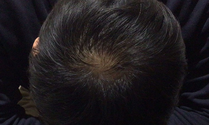 京都のAGA・薄毛治療専門院の発毛症例