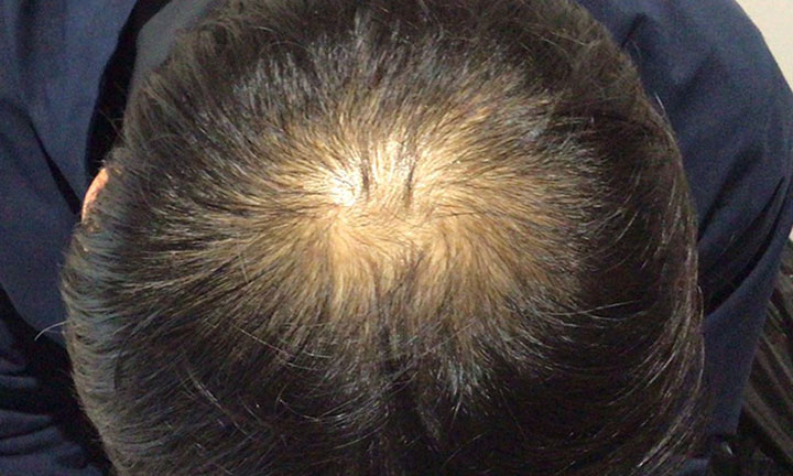 京都のAGA・薄毛治療専門院の発毛症例