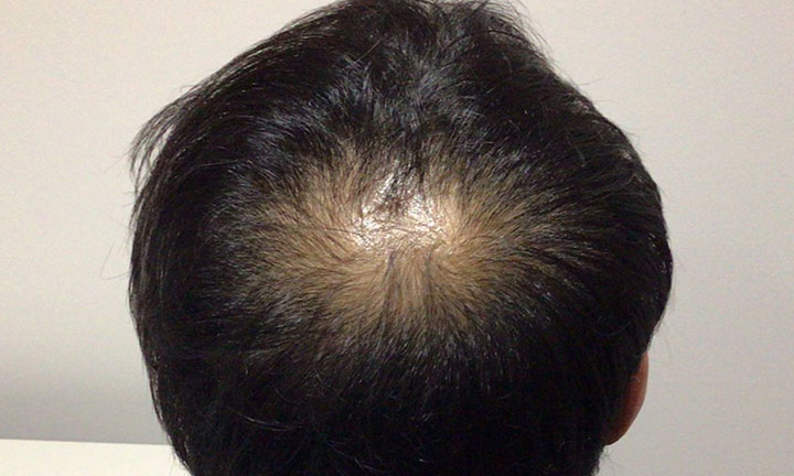 京都のAGA・薄毛治療専門院の発毛症例