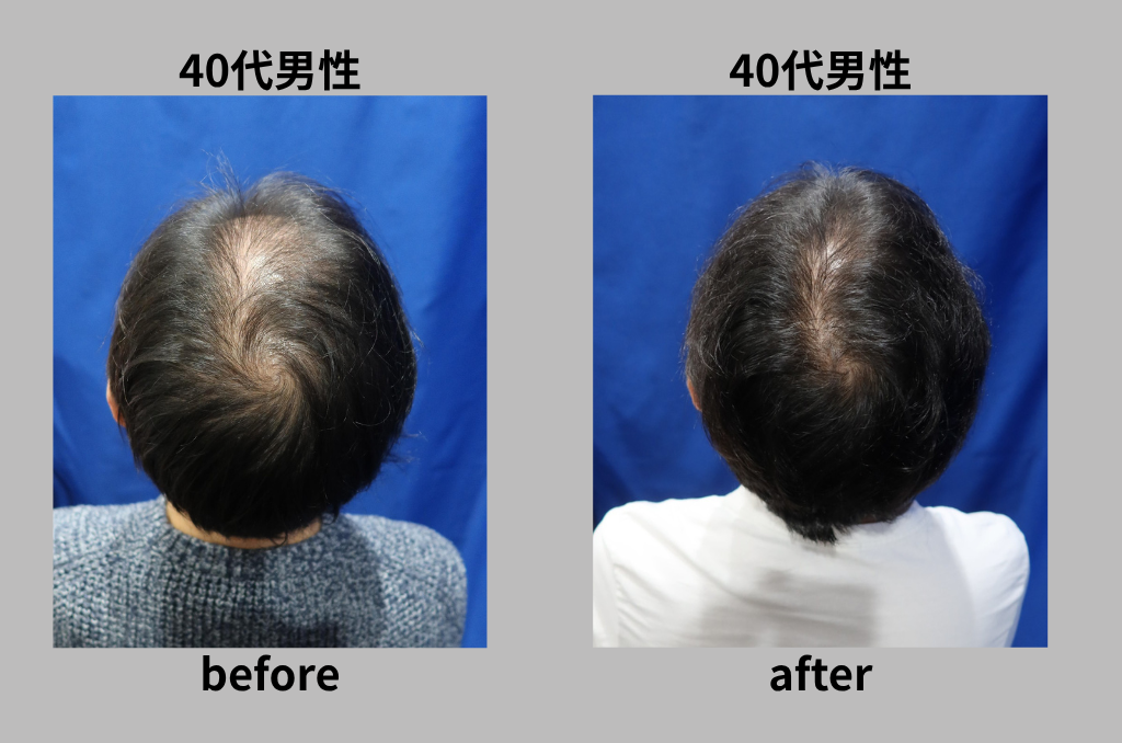 46歳男性】8ヶ月でここまでの発毛効果！ - 大阪AGA加藤クリニック