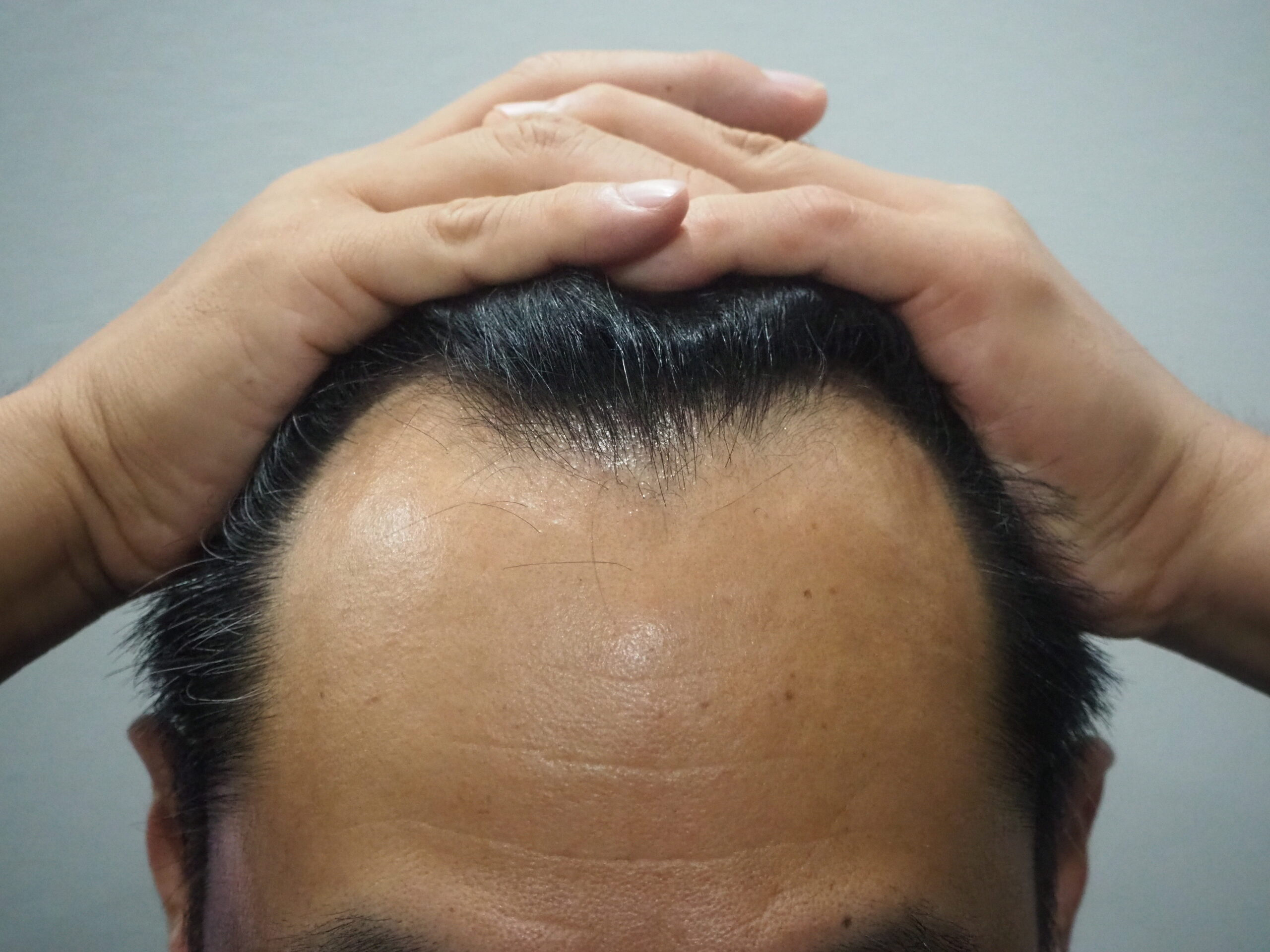 大阪AGA加藤クリニックでの実際の治療例：「50代／男性M字型 男性用総合発毛治療薬　Pro Hair＋、PRP注入療法」